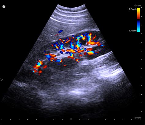 Ultrasound Machines For Kidney Imaging Bk Medical