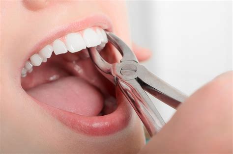 Is A Tooth Extraction Painful A Dentist Weighs In