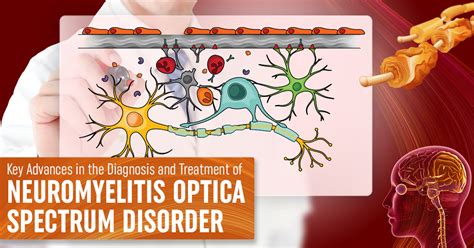Key Advances In The Diagnosis And Treatment Of Neuromyelitis Optica