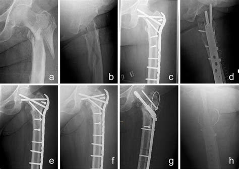 Fixation Failure Of The Lcp Proximal Femoral Plate 4550 In Patients