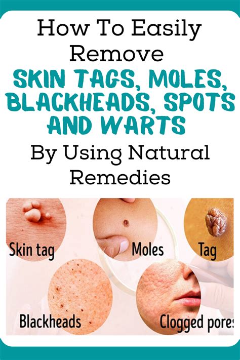 how to easily remove skin tags moles blackheads spots and warts by using natural remedies