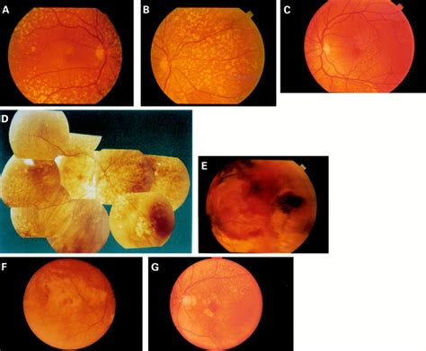 Sorsby Fundus Dystrophy Without A Mutation In The Timp 3 Gene British
