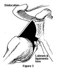 These ligaments are main source of stability for the shoulder. Shoulder Instability | Johns Hopkins Medicine Health Library