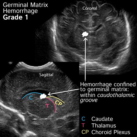 Pathology Glossary Germinal Matrix Hemorrhage Gmh Draw It To Know It