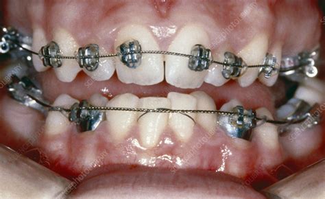 Braces For Crowded Teeth Stock Image C0272148 Science Photo Library