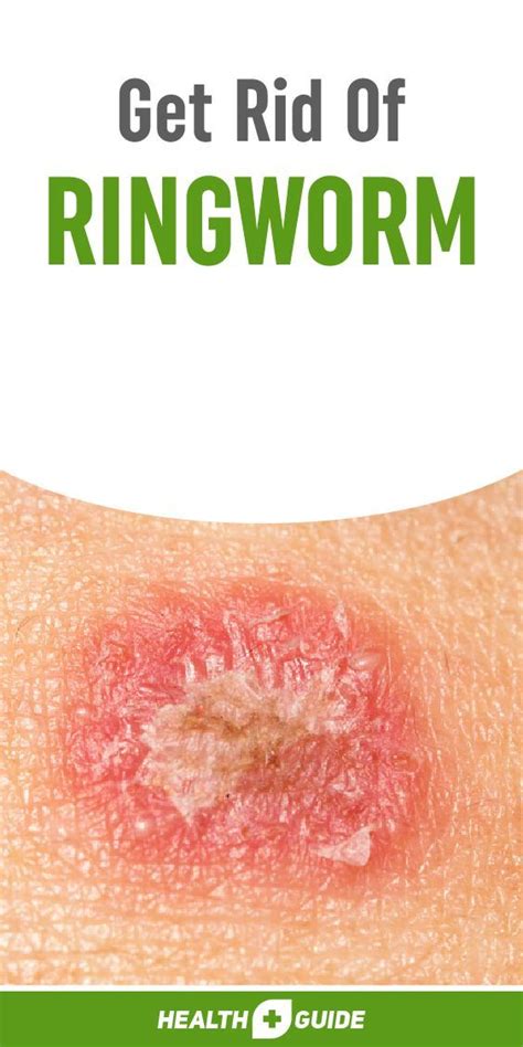 8 Tips To Get Rid Of Ringworm Quickly Get Rid Of Ringworm Health