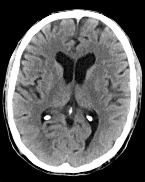 Iv contrast does not cross the normal blood brain barrier and is used if there is a. Image: Normal Head CT Scan (Adult, Age 74) - Slide 5 ...