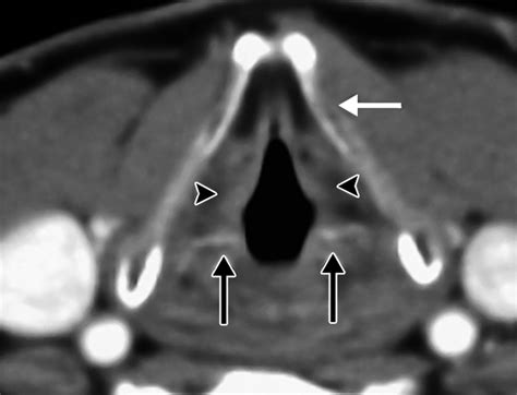 Ct Findings After Laryngectomy Radiographics