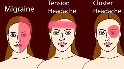 Headache Common Headaches Migraine Tension Headache Cluster Headache Youtube