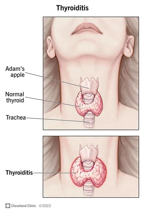 Penyakit Tiroiditis Definisi Penyebab Gejala Dan Tata Laksana AI
