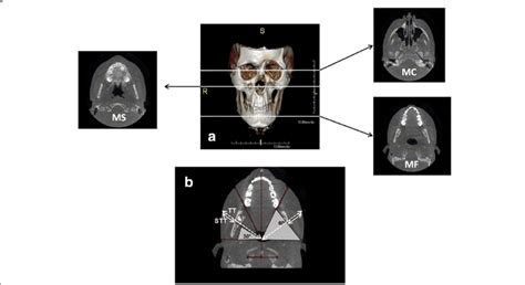 A 3d Cone Beam Computed Tomography Cbct Showing The Levels Of The