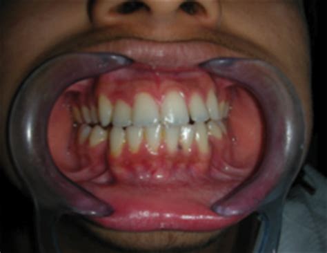 Clinical Photography A To Z Apos Trends In Orthodontics