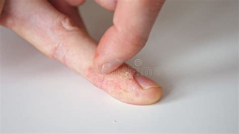 Fingers Of A Man With Psoriasis And Eczema Stock Footage Video Of