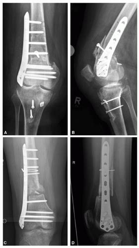 Distal Femur Rotational Osteotomy Musculoskeletal Key