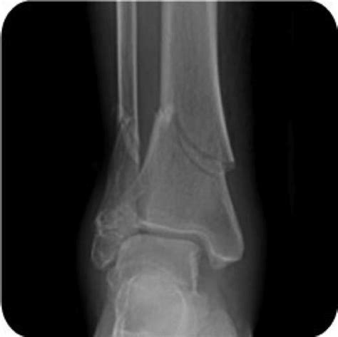 Tibial Shaft Fractures Trauma Orthobullets