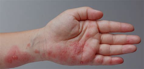 Is Shingles Contagious Everything You Need To Know About Shingles