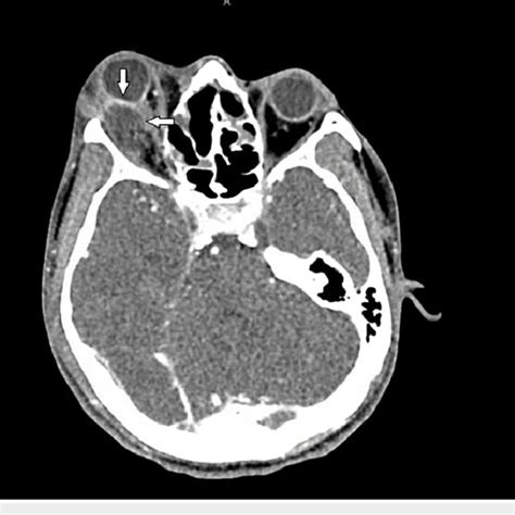 Ct Orbit From The Second Visit Showing An Axial View With A Right