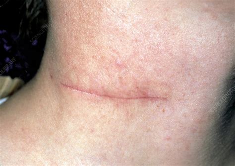 Scar On The Neck After Removal Of Branchial Cyst Stock
