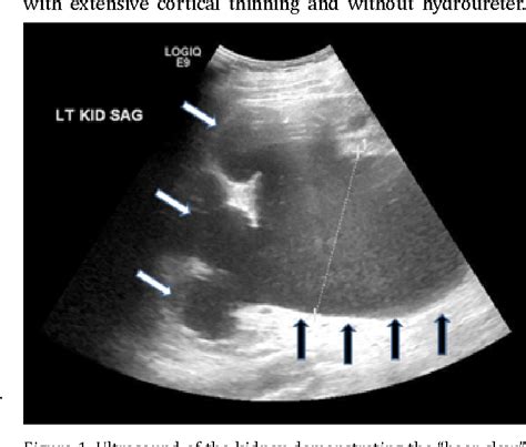 Pdf Congenital Ureteropelvic Junction Obstruction Semantic Scholar