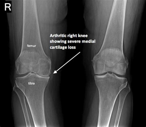 This is why you get down on one knee to propose. reader's digest. Knee Xray - Century City Los Angeles, CA: Millstein ...