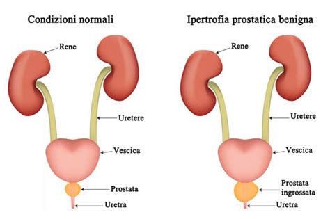 Ipertrofia Prostatica Benigna Guardia Medica Privata Roma Romamed