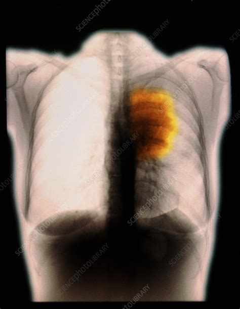 coloured chest x ray showing a lung cancer stock image m134 0332 science photo library