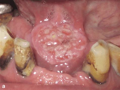 A Oral Squamous Cell Carcinoma In The Floor Of The Mouth Conventional