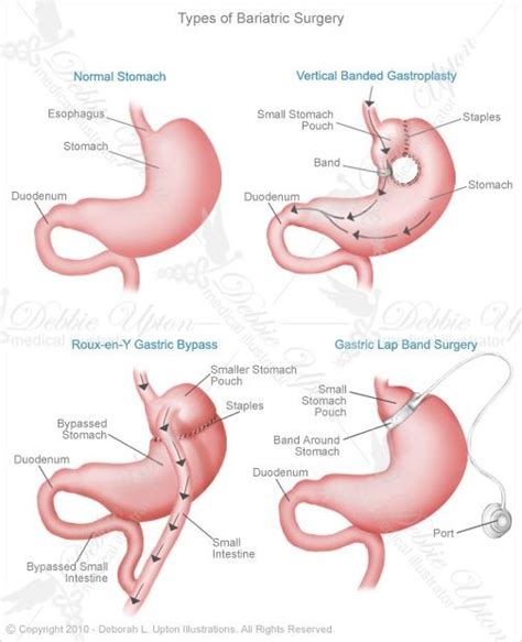 Pin By Connie Chi On Medical Anatomy Illustration Lap Band Surgery Bariatric Bariatric Surgery