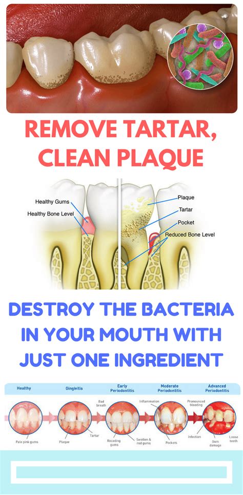 Remove Tartar Clean Plaque And Destroy The Bacteria In Your Mouth With