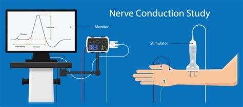 ALS (Amyotrophic Lateral Sclerosis) Nerve Tests | Alstreatment.com