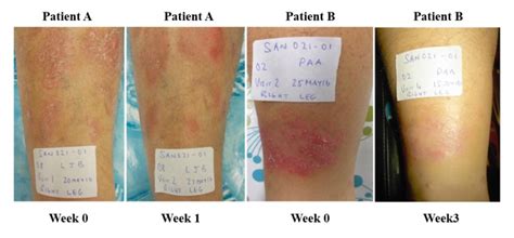 Figure 5 Psoriasis Lesions In Two Patients Before Treatment And