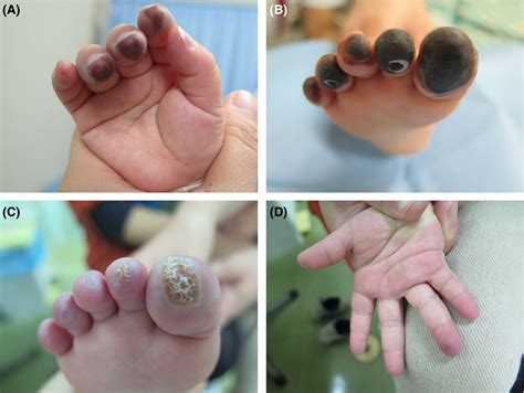 A Serious Case Of Primary Raynauds Phenomenon In An Infant Kobayashi