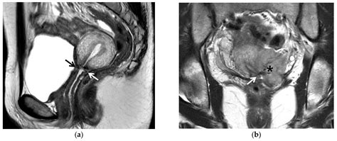 Cancers Free Full Text Useful Mri Findings For Minimally Invasive