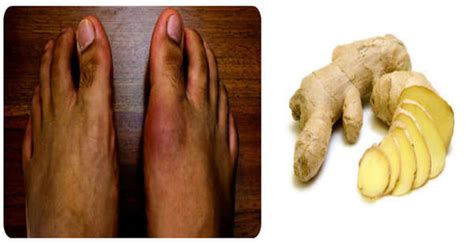 8 Most Effective Home Remedies For Gout