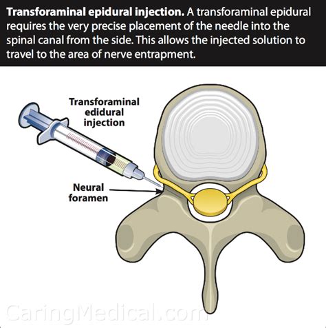 Cervical Epidural Steroid Injections In Complicated Neck Pain Cases