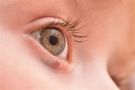 Eyelid Cancer Types Symptoms And Treatment