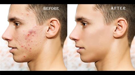 Photoshop Tutorial How To Clean Face Remove Pimple Remove Acne