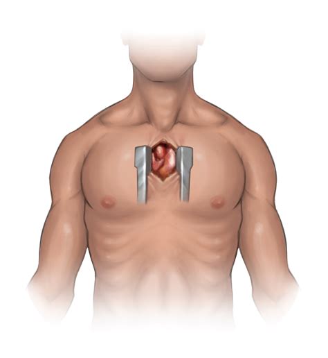 Aortic Stenosis The Keyhole Heart Clinic