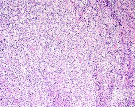 Diffuse Large B Cell Lymphoma Anaplastic Variant 1
