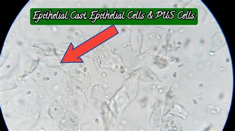 Pus is thick glue tips to treat pus cells in urine: Epithelial Cast, Epithelial Cells & PUS Cells Under the ...