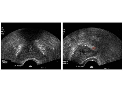 Transrectal Ultrasound Of Prostate Telegraph