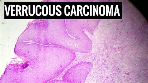 Verrucous Carcinoma How To Diagnose Youtube