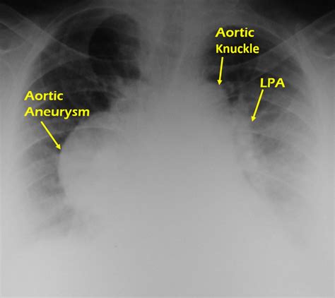 X Ray Chest Pa View In Aortic Aneurysm All About Cardiovascular