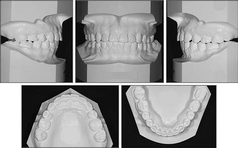 Figure 12 From Orthodontic Uprighting Of A Horizontally Impacted Third