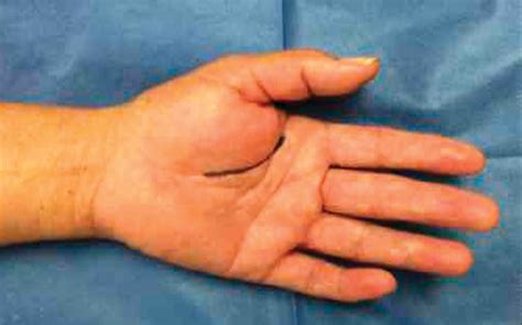 Giant Palmar Lipoma An Unusual Cause Of Carpal Tunnel Syndrome
