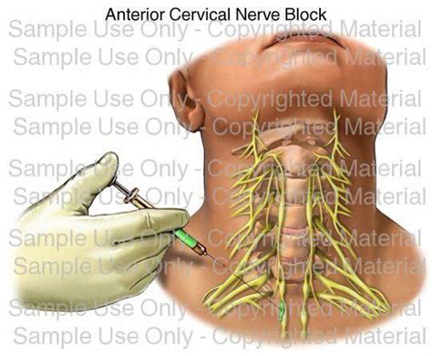 Occipital Neuralgia Cervical Nerve Block Headachevsmigraine