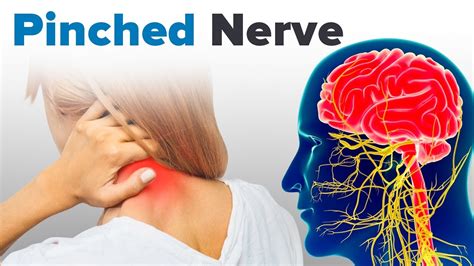 Understanding Pinched Nerves And How They Cause Anxiety Youtube