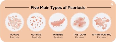 Psoriasis Symptoms Causes Types And Ayurveda Treatment Theayurveda