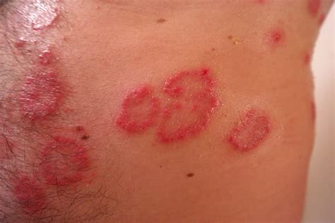 8 Proven Eczema Removal Tips Symptoms Causes And