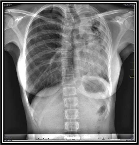 Chest X Ray Demonstrating Mediastinal Shift Secondary To Left Lung